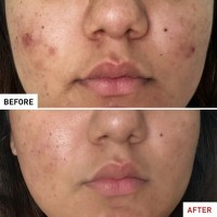 portrait-before-after-centella-acne-careuk9-16